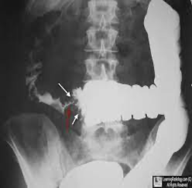 <p>Leading cause of death from cancer in the US</p><p>Most common annular carcinoma- in sigmoid and rectum</p><p>Btw ages 50-70 occur</p><p>Can develop from polyps and colitis</p>