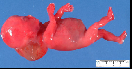 <p>lymphatic obstruction leading to fluid accumulation</p>