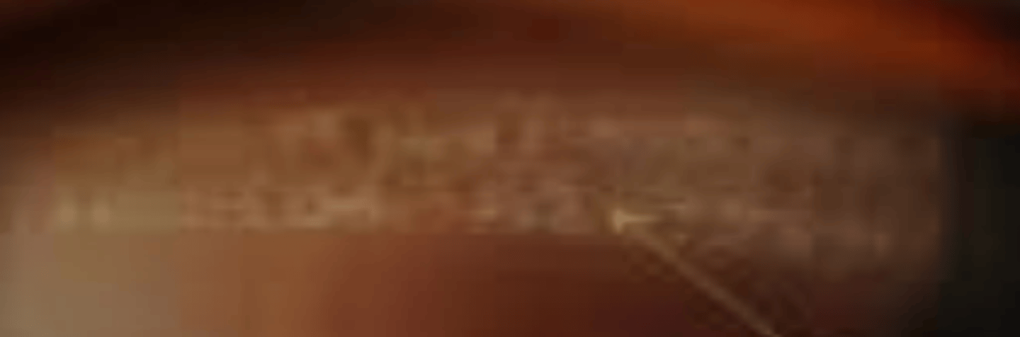 <p>retinal finding that is the same as lattice degeneration, but with no pigment or sclerosed vessels. Is a precursor to lattice degeneration and its management is the same.</p>