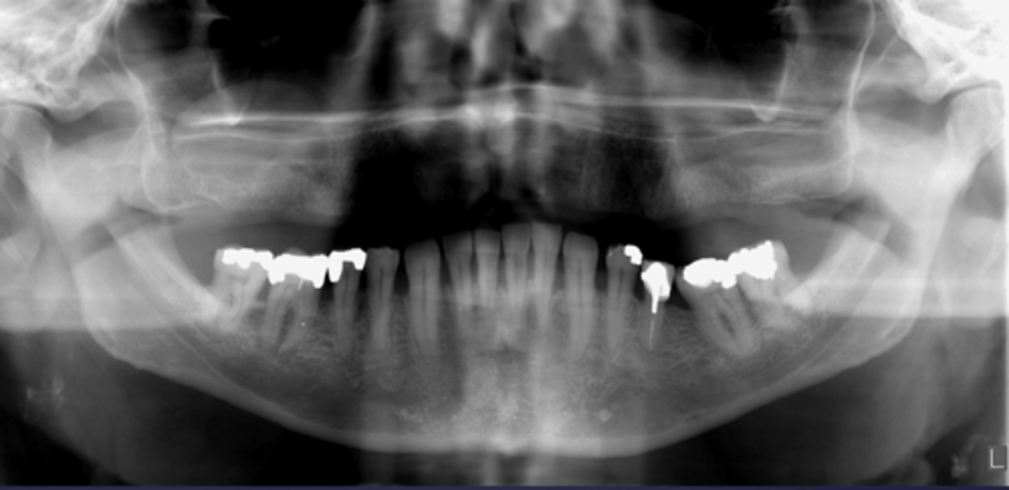 <p>What would be a differential diagnosis for this lesion?</p>