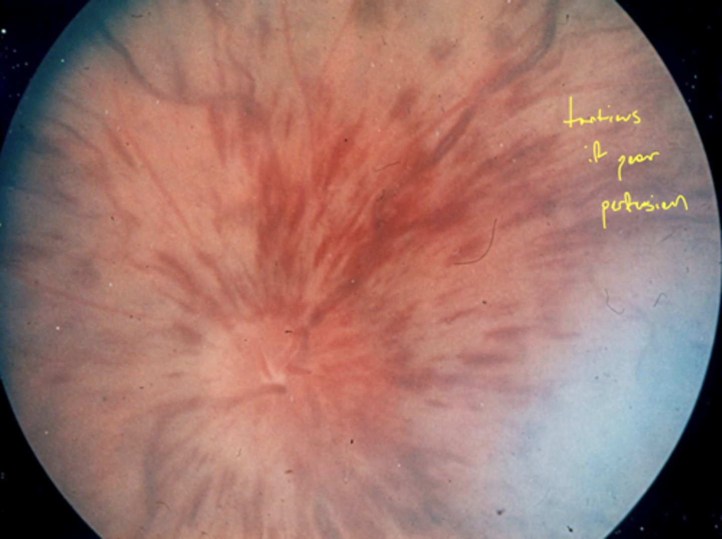 <p>1. more dot-blot + flame hemes</p><p>2. CWS</p><p>3. significant macular + ONH edema</p>