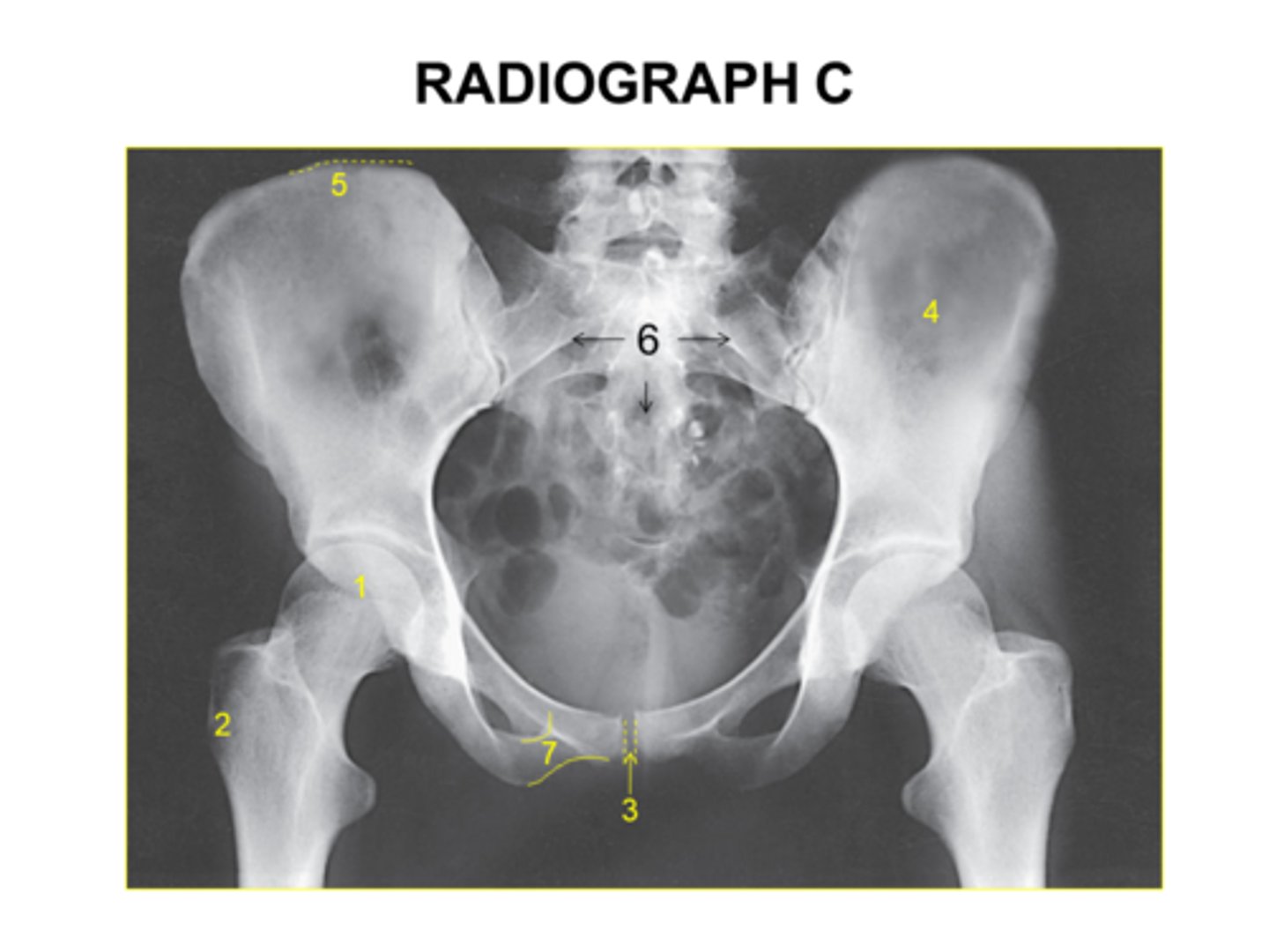 <p>Identify the anatomy marked with #7:</p><p>Pubic symphysis</p><p>Ischial tuberosity</p><p>Pubic bone</p><p>ilium</p>