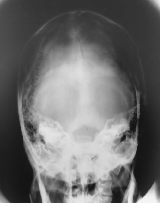 <p>What is this X-ray demonstrating?</p>
