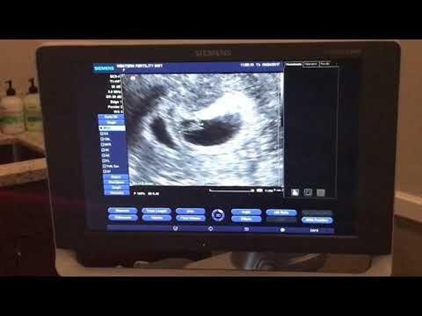 <p>Sound wave procedure to monitor fetal health.</p>