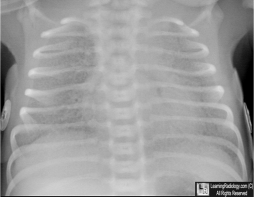 <p>Hyaline Membrane Disease</p>