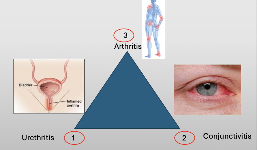 <p>A chronic disease that classically compromises a triad of three featuers:</p><ul><li><p>Urethritis</p></li><li><p>Conjunctivitis</p></li><li><p>Arthritis</p></li></ul><p></p>