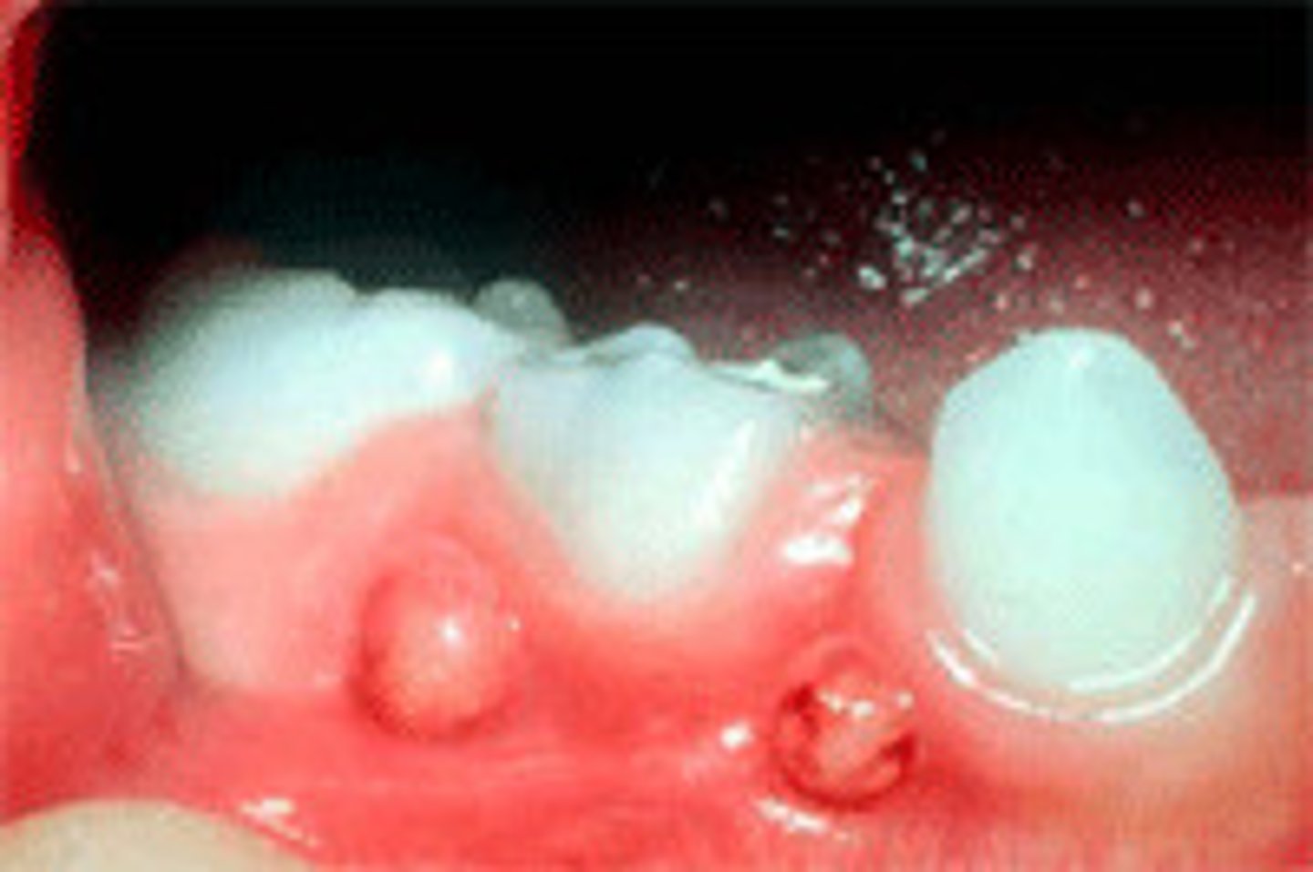 <p>________________: A collection of pus</p>