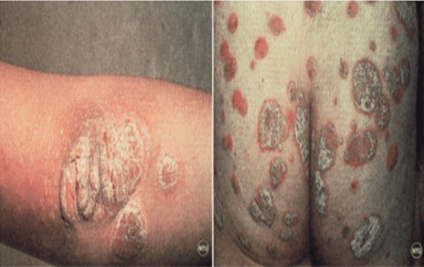<p>-Chronic skin disorder that can occur at any age</p><p>-Develops by age 20</p><p>-Inflammation of cytokines from helper T-cells causes overacting immune system</p><p>Treatment:</p><p>-UV light</p><p>-Creams</p>