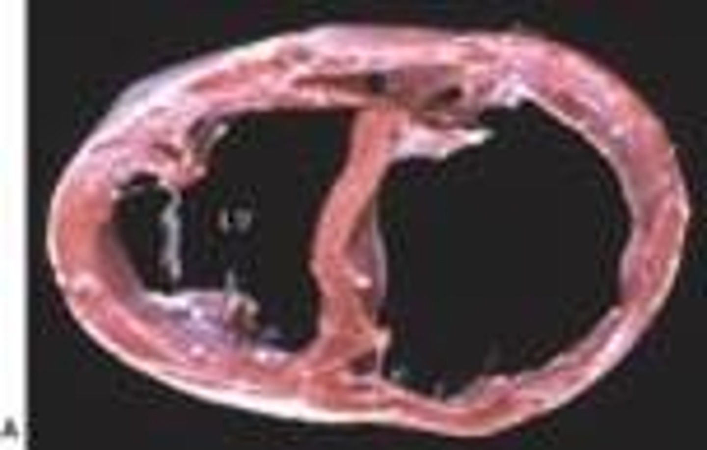 <p>eccentric hypertrophy</p>