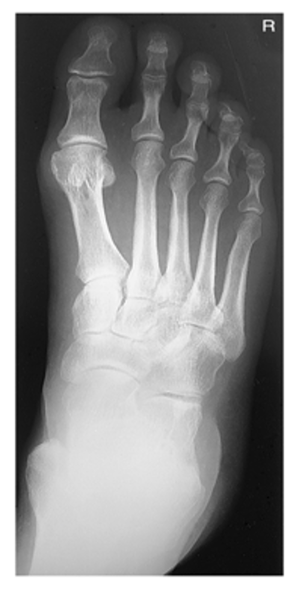 <p>- CR 10° angled posteriorly</p><p>- CR to base of 3rd MT</p><p>- Entire foot visualized</p><p>- No rotation of metatarsals</p><p>- MTP joints generally open</p><p>- Optimal exposure factors</p>