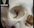 <p>an incomplete supraorbital foramen</p>