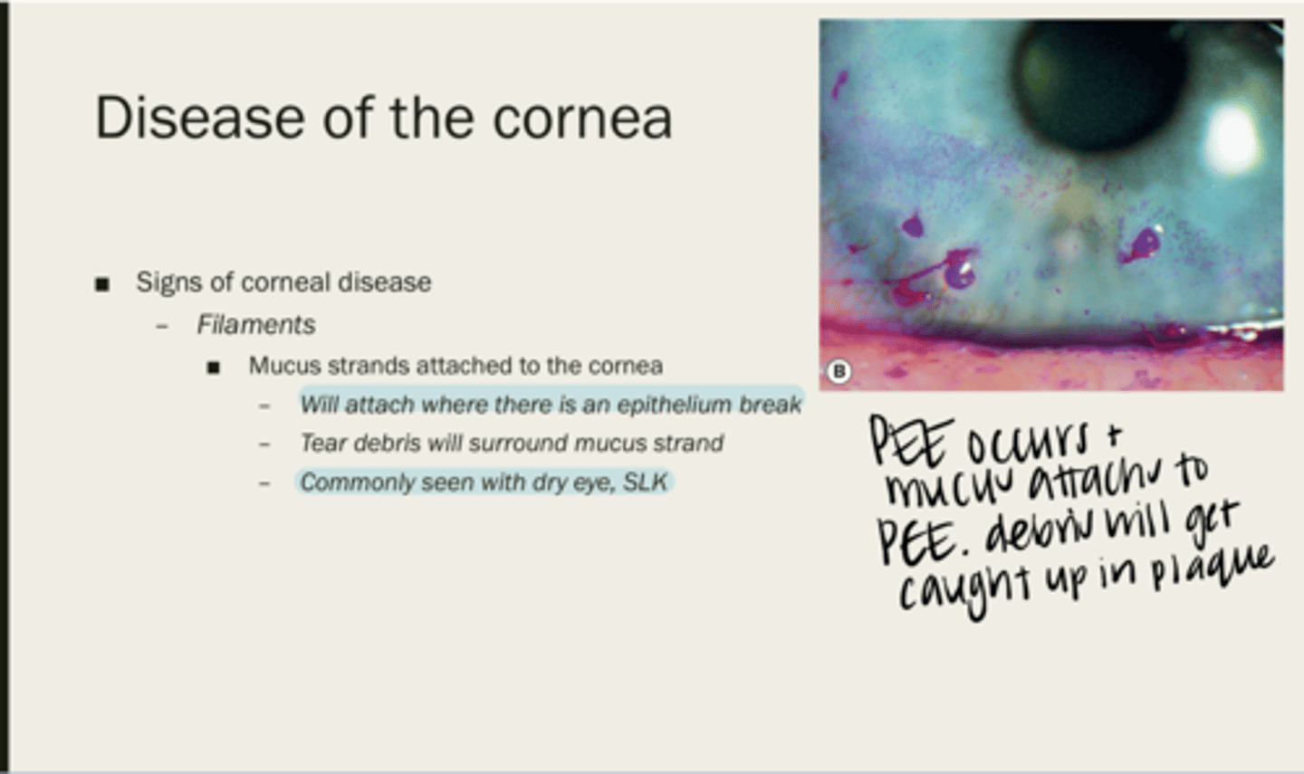 <p>mucus strands attached to the cornea</p>