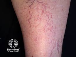 <p><span>Prominent, dilated superficial blood vessels.</span></p>