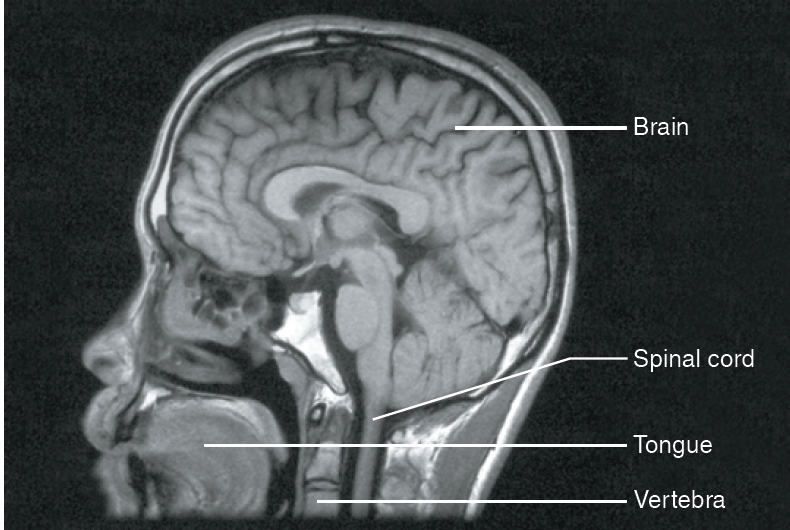 <p>The magnetic resonance image (MRI) shown is a ____ section of the head</p>