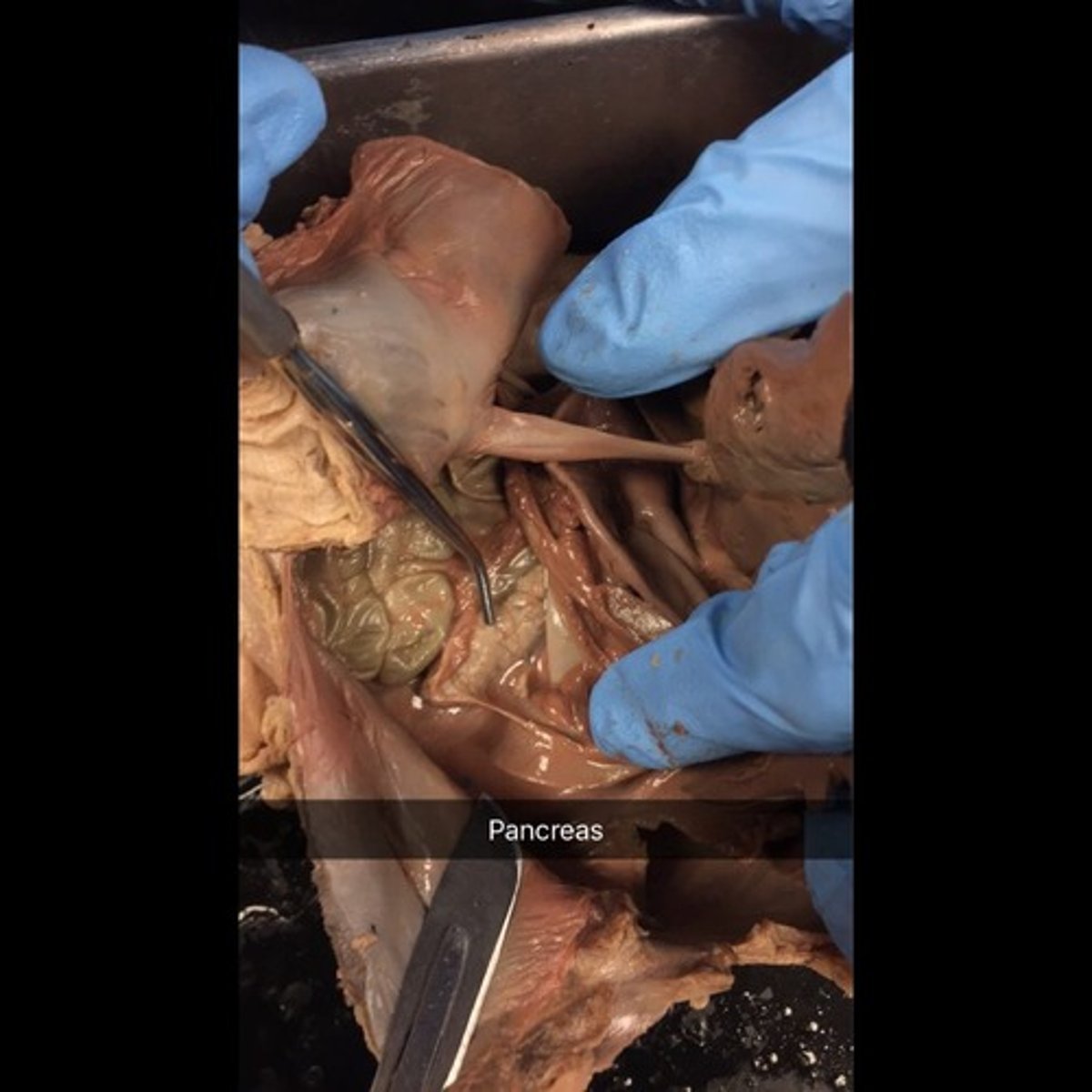 <p>It is located attached to the posterior wall of the cavity. 99% exocrine function, acini produces pancreatic juice, secretes zymogen granules= inactive enzymes that get activated in the small intestine, produces enzymes that break down ALL categories of food</p><p>1% endocrine function to secrete insulin and glucagon produced by pancreatic islets. Provides bicarbonate ions for proper pH</p>