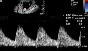<p>If we are dopplering at the umbilical artery, would this image indicate normalcy or abnormality? </p>