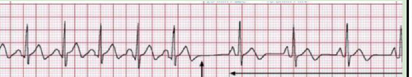 <p>Failure of the sinus node → brief pause → takeover of rhythm by another atrial impulse</p><p>-P wave will differ following pause </p>