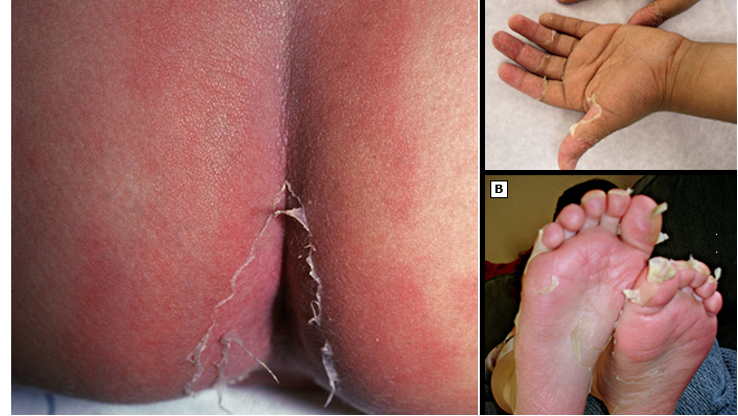 <ul><li><p>fever</p></li><li><p>cutaneous/mucosal erythema and edema w/ subsequent desquamation</p></li><li><p>bilateral non exudative conjunctivitis</p></li><li><p>polymorphous exanthem</p></li><li><p>cervical LAD</p></li><li><p>cracked, cherry red lips and oropharyngeal erythema</p></li><li><p>erythema of palms/soles</p></li></ul><p></p>