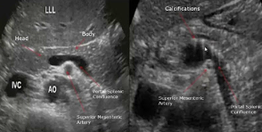 <p>What pathology is suggested by the findings in the image on the right? (left is normal)</p>