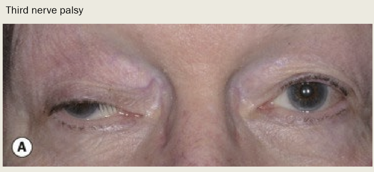 <p>Innervational defects, such as 3rd nerve palsy, Horner’s Syndrome, and marcus gunn jaw winking syndrome. </p>