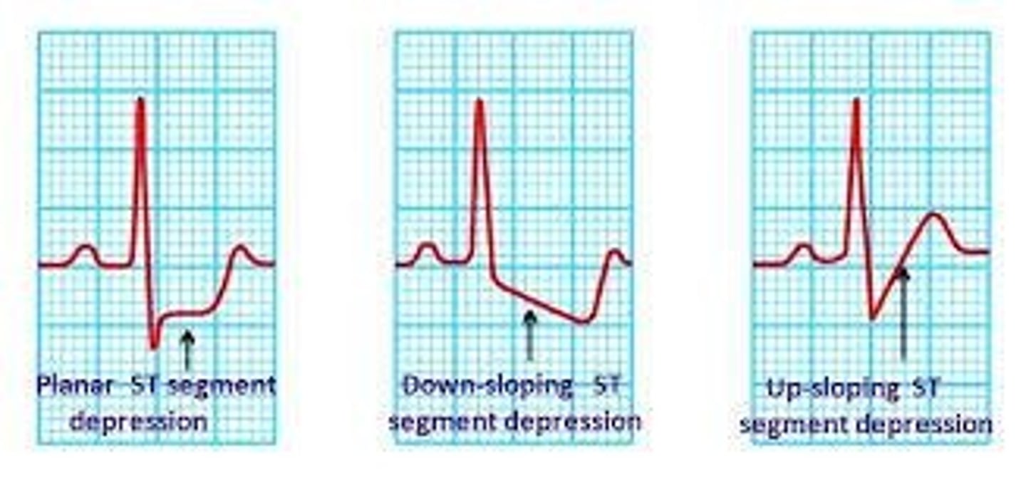 <p>Indications of ischemia such as ST segment depression or elevation during exercise.</p>
