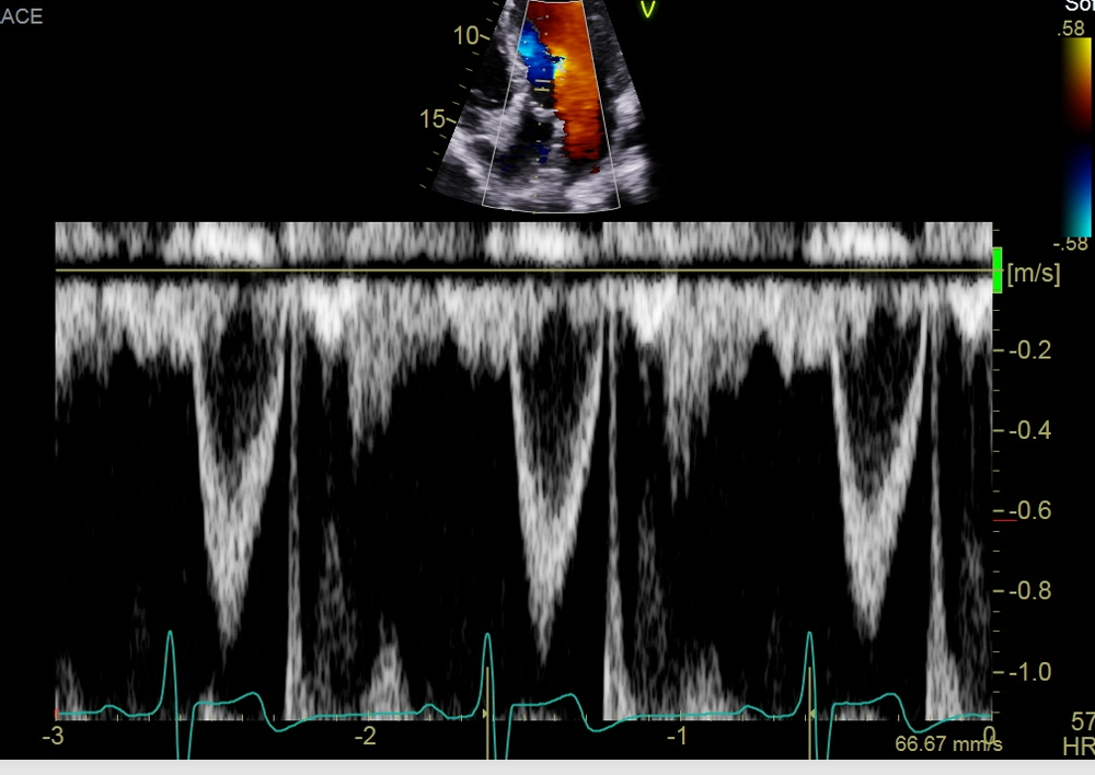 <p>perform LVOT PW doppler for SV with proper gate size (2-5)</p>