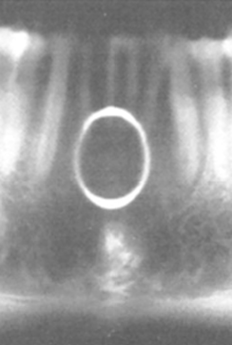 <p>In this image, the teeth are ___ the groove of the bitestick</p><p>A) in front of</p><p>B) behind</p>