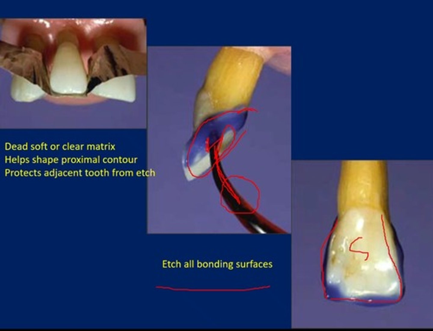 <p>etch all the bonding surfaces of the tooth.</p>