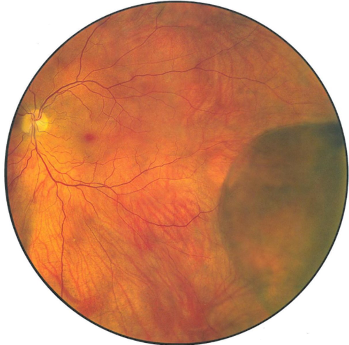 <p>monitor</p><p>refer for photocoagulation if holes</p>