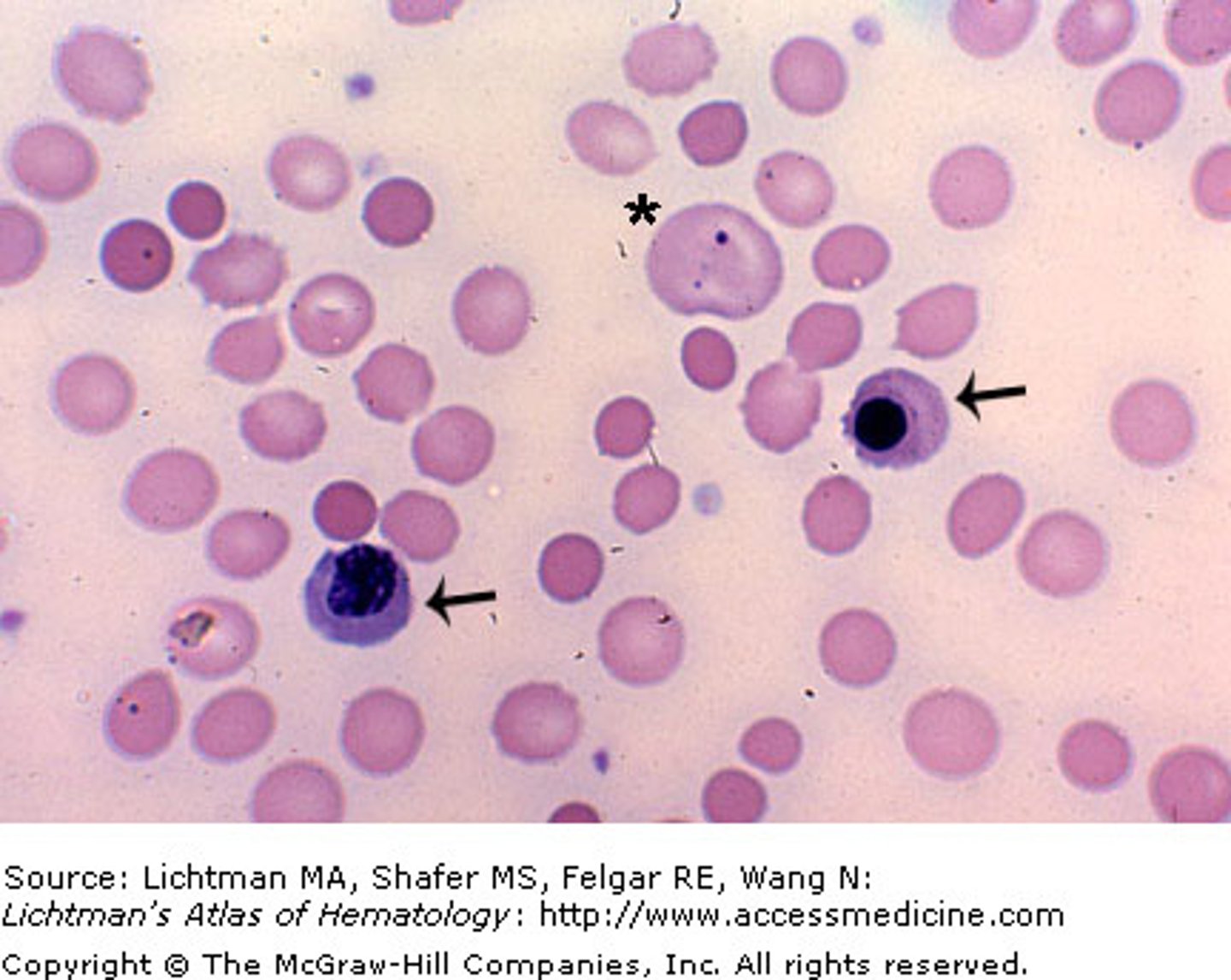 <p>an immature red blood cell that has not yet lost its nucleus</p><p>-seen as a result of contamination from bone marrow during the spinal tap</p>