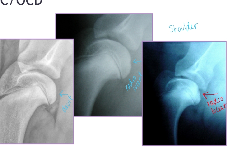 <ul><li><p><span style="background-color: transparent;"><strong><span>Et:</span></strong><span> </span></span><span style="background-color: transparent; color: red;"><span>Defect in normal endochondral ossification</span></span></p><ul><li><p><span style="background-color: transparent; color: red;"><strong><span>Shoulder(most common)</span></strong><span>, Elbow, Stifle, Hock</span></span></p></li></ul></li><li><p><span style="background-color: transparent;"><strong><span>Path:</span></strong><span> </span><strong><span>Failure of cartilage to ossify → thickened cartilage (OC)</span></strong><span> → poor nutrition → mechanical trauma → </span><strong><span>cartilage fissuring/flap(OCD) → synovial inflammation → pain</span></strong></span></p></li></ul><ul><li><p><span style="background-color: transparent;"><strong><span>Sig:</span></strong><span> </span></span><span style="background-color: transparent; color: red;"><strong><span>Juvenile large breed dogs</span></strong></span></p></li></ul><ul><li><p><span style="background-color: transparent; color: red;"><strong><span>Cs: Lameness, Pain, Decreased ROM, Muscle atrophy, Joint effusion palpable</span></strong></span></p></li><li><p><span style="background-color: transparent;"><strong><span>Dt: </span></strong><span>Radiographs, CT</span></span></p><ul><li><p><span style="background-color: transparent;"><strong><span>Caudal humeral head</span></strong><span> – lateral view</span></span></p></li><li><p><span style="background-color: transparent;"><strong><span>Medial humeral condyle</span></strong><span> – oblique view(elbow)</span></span></p></li><li><p><span style="background-color: transparent;"><strong><span>Medial aspect of lateral</span></strong><span> </span><strong><span>femoral condyl</span></strong><span>e – AP view</span></span></p></li><li><p><span style="background-color: transparent;"><strong><span>Medial/lateral trochlear ridges of hock</span></strong><span> – AP/oblique views</span></span></p></li></ul></li></ul><ul><li><p><span style="background-color: transparent;"><strong><span>Tx: </span></strong></span><span style="background-color: transparent; color: red;"><strong><span>Arthrotomy, arthroscopy, remove cartilage flap, debridement of subchondral bleeding bone</span></strong></span></p></li></ul><ul><li><p><span style="background-color: transparent;"><strong><span>Px: </span></strong></span></p><ul><li><p><span style="background-color: transparent;"><strong><span>Shoulder: </span></strong><span>excellent</span></span></p></li><li><p><span style="background-color: transparent;"><strong><span>Elbow/Stifle:</span></strong><span> good</span></span></p></li><li><p><span style="background-color: transparent;"><strong><span>Hock:</span></strong><span> guarded</span></span></p></li></ul></li></ul><p></p>