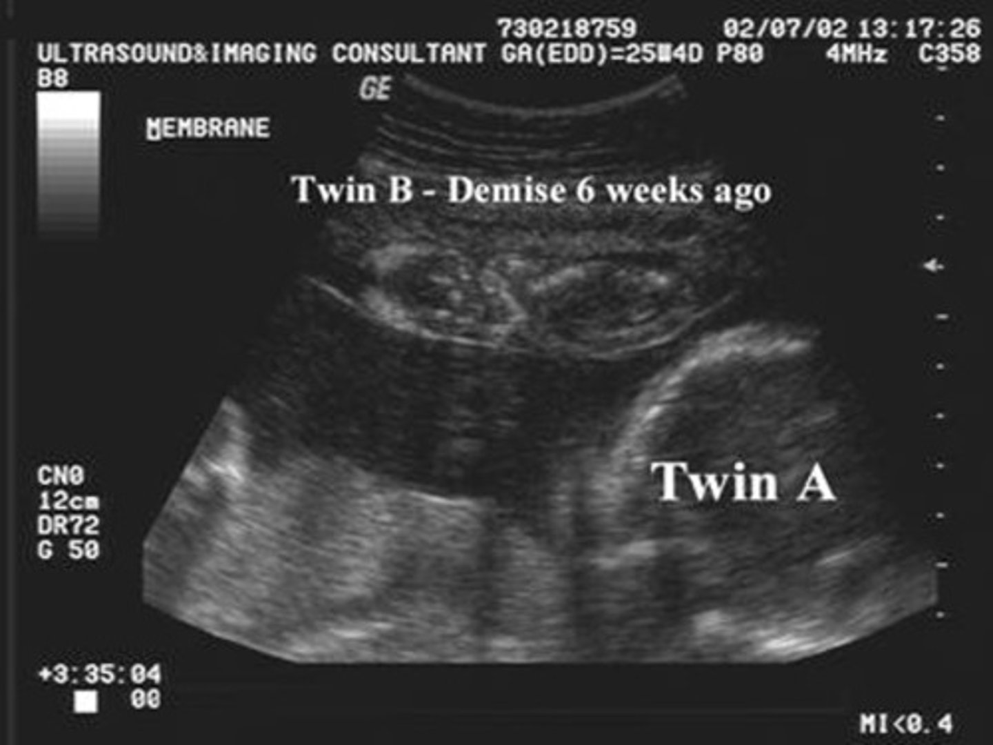<p>Fetus papyraceus</p>