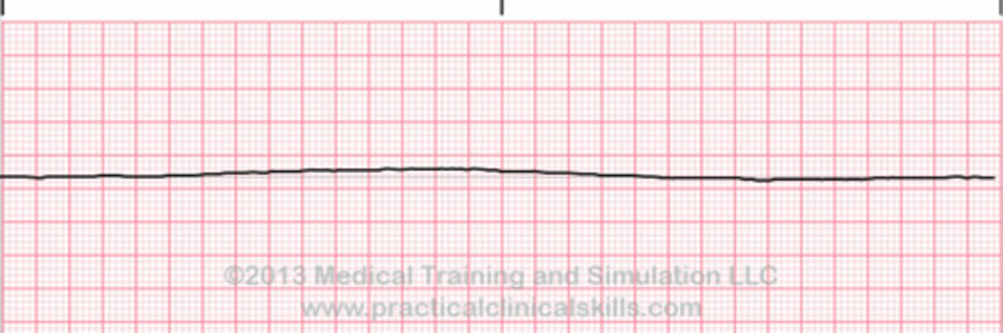 <p>- no electrical or mechanical activity of the heart</p><p>- no palpable pulse or blood pressure</p><p>- treatment: focus on high-quality CPR, identifying reversible causes, give epinephrine</p>
