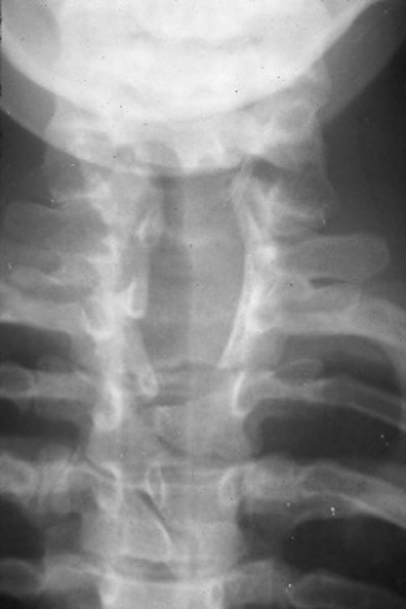 <p>Clinical significance of Spina Bifida Vera</p>