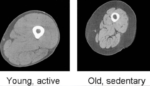 <p>Weight/muscle loss due to old age.</p><p>Reduction in muscle fibres.</p><p>Affects ‘normal’ activity</p>