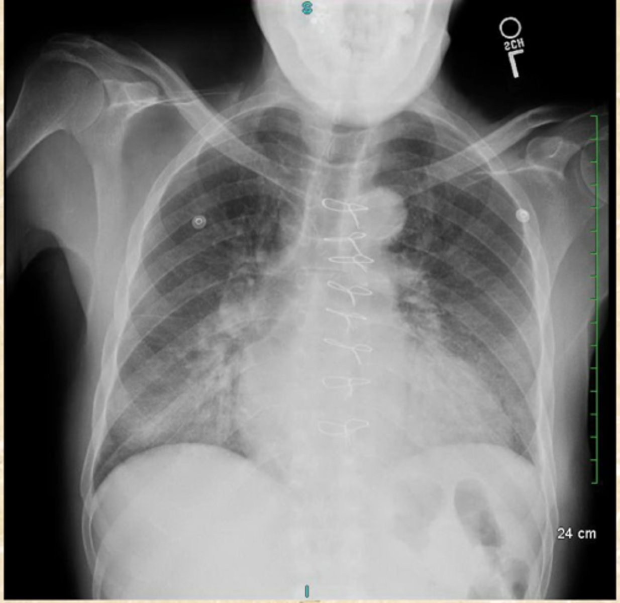 <p>What does this CXR show?</p>