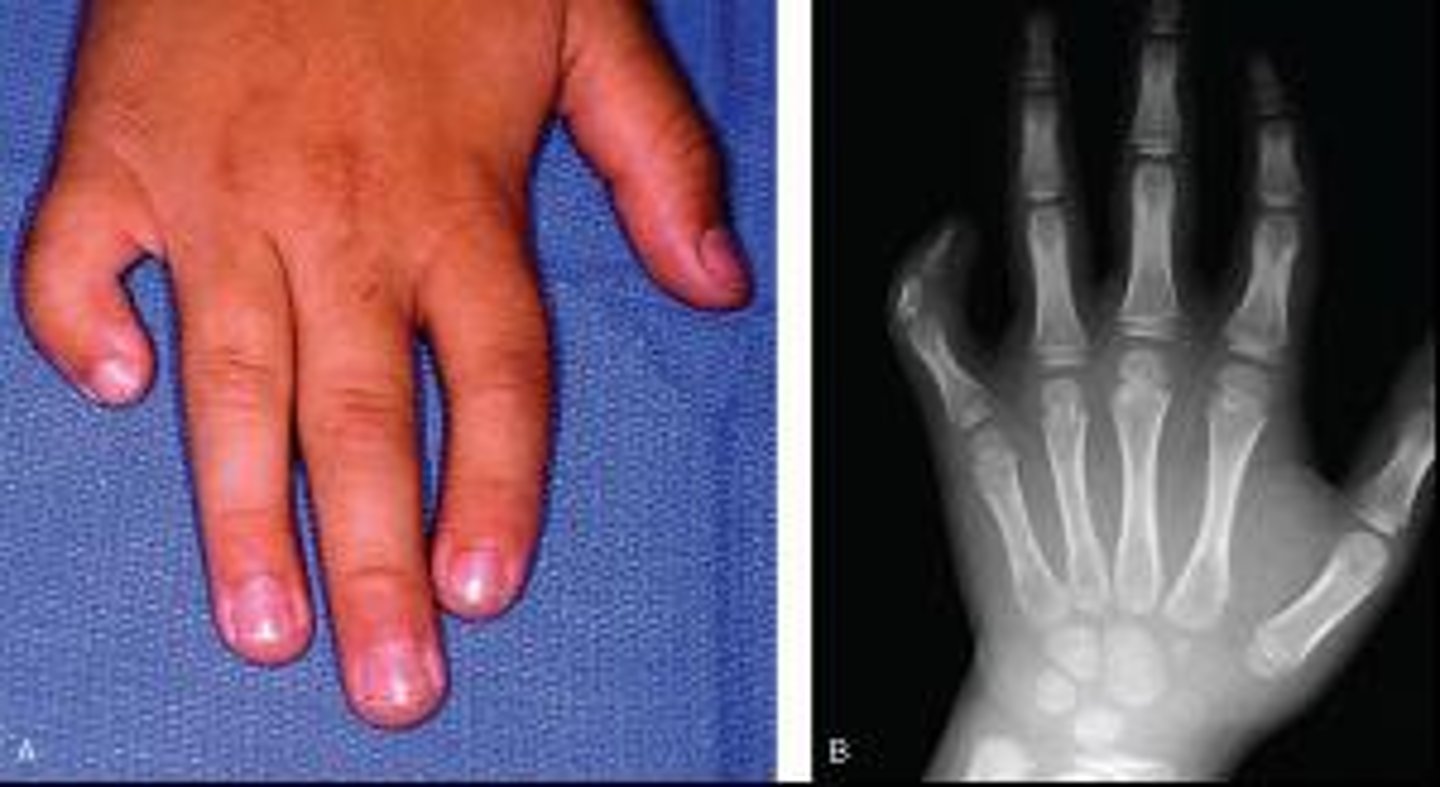 <p>Clinodactyly</p>