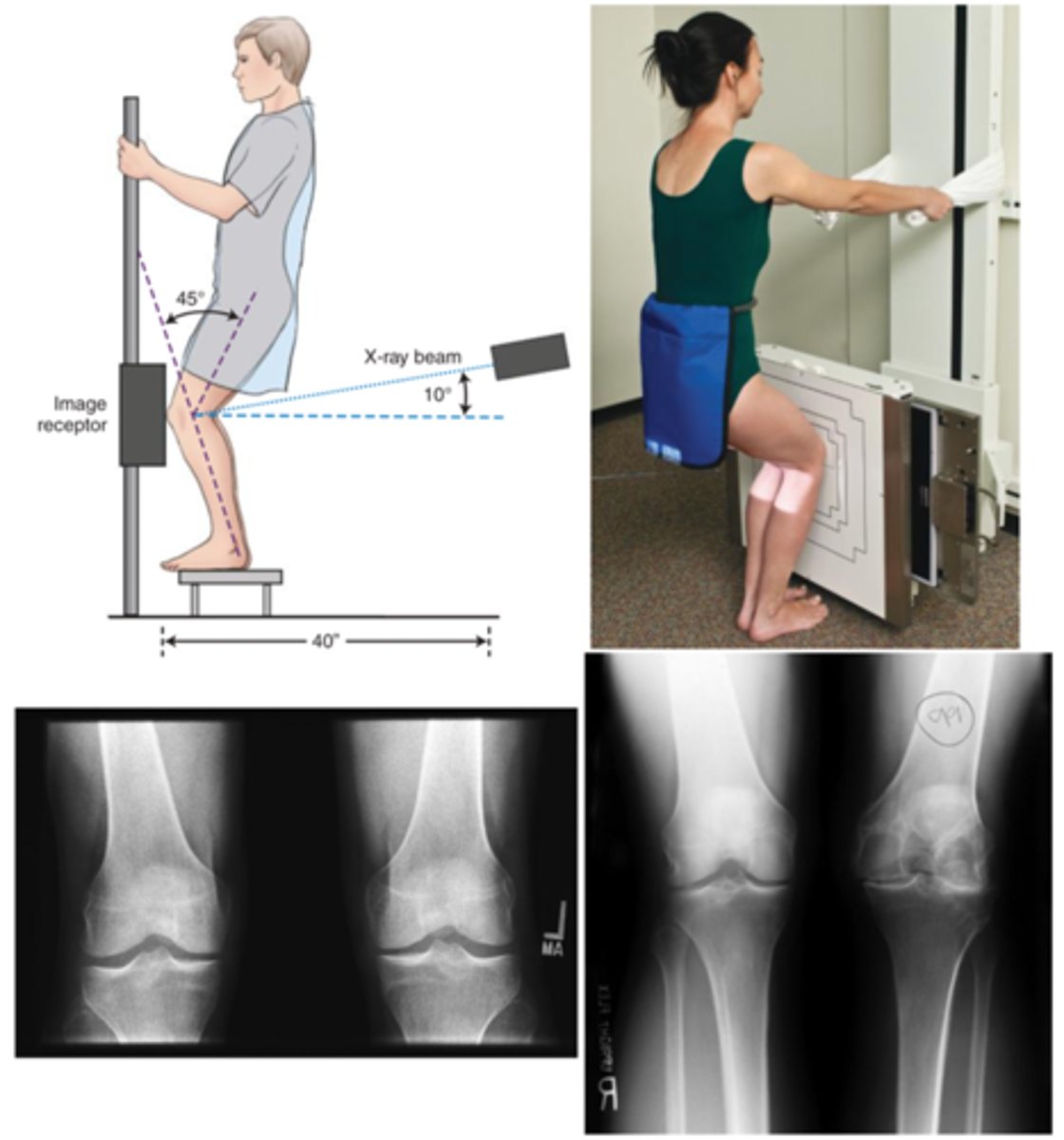<p>- this projection is more sensitive &amp; specific for the actual knee joint space</p><p>- therefore it is useful for the assessment of knees with early degenerative changes.</p>