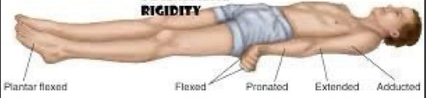 <p>UE and LE in extension, adduction, int rot</p><p>Wrist/fingers in flexion</p><p>Lesion below superior colliculus, brainstem region</p><p>Poorer prognosis than clients with damage above superior colliculus</p>