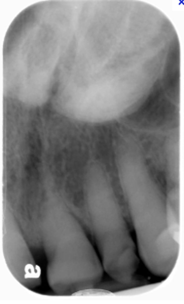 <p>What is the diagnosis?</p><p>Patient presents with a dense, radiopaque shadow in the midline of the hard palate area that has a well defined periphery and is superimposed over the roots of the maxillary teeth. Patient opens their mouth and the etiology is visible.</p>