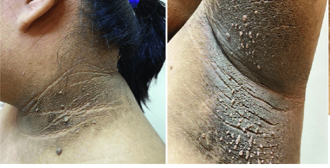 <p>hyperpigmented, shiny change especially in areas of skin folds</p>