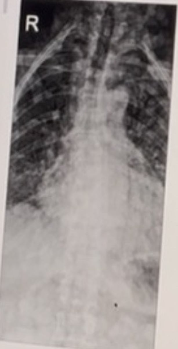 <p>Adult patient with known chronic condition. The patient also demonstrates multiple smooth margin, non-elevated darkly pigmented skin lesions on their thorax.</p><p>The most common radiographic finding for this patient's diagnosis is:</p><p>• Cortical khickening</p><p>• Ground glass appearance</p><p>• Kyphoscoliosis</p><p>• Subligamentous vertebral destruction</p>
