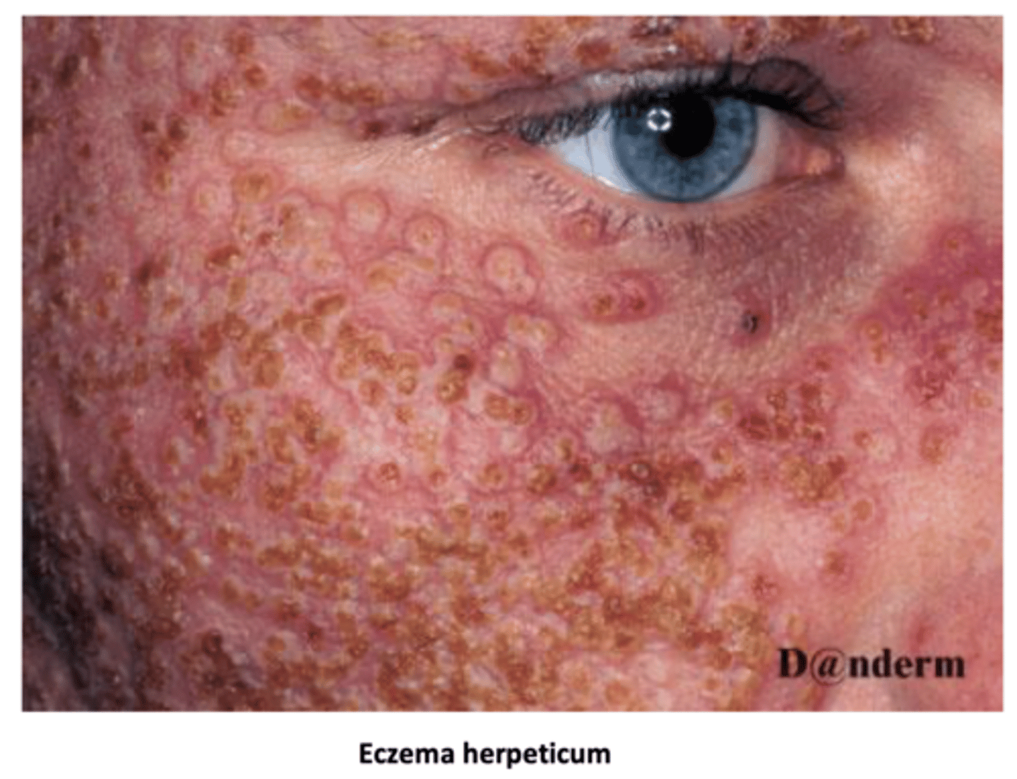 <p>- caused by herpes simplex virus</p><p>- Extensive crusted papules, blisters and erosions which are painful</p><p>- Systemically unwell with fever and malaise</p>