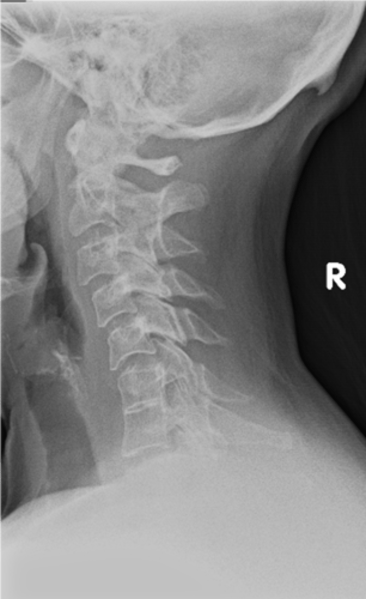 <p>Congenital fusion</p>