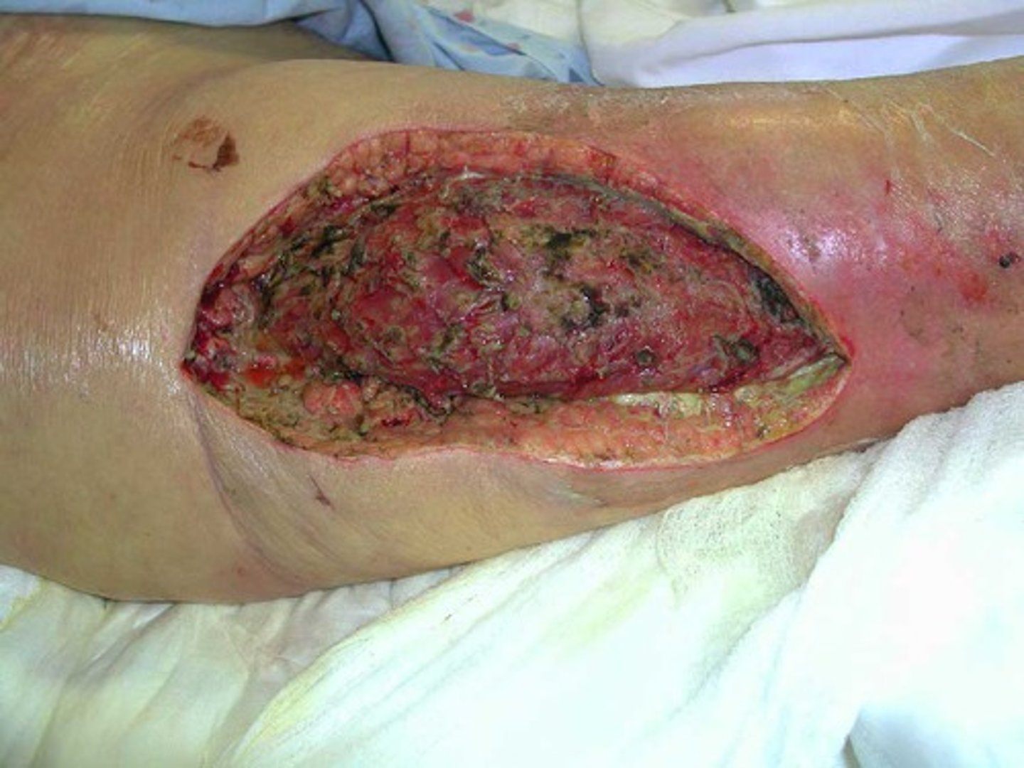 <p>“Flesh-eating” disease - Caused by host immune system overreacts to S. pyogenes pyrogenic toxins</p>