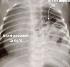 <p>Diaphragmatic hernia</p>