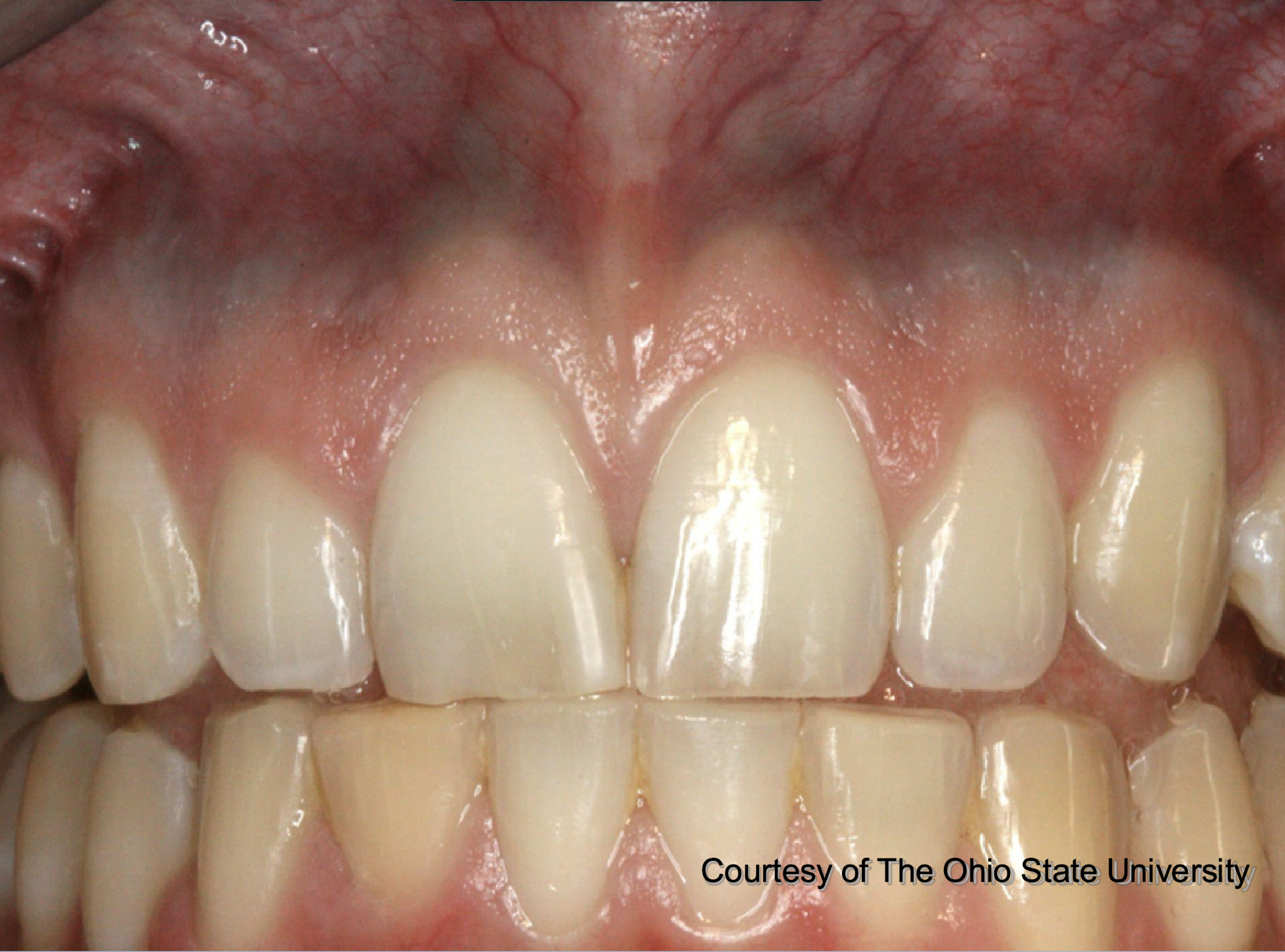 <p>pt also has pigmented lesions in vestibule, on palate, tori, etc </p>