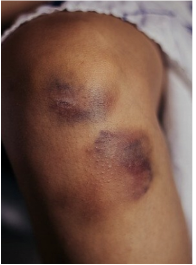 <p><span>How would you find this skin finding?</span></p><p></p>