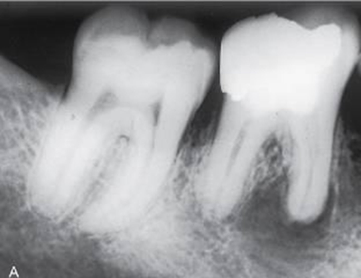 <p>pulpal inflam and necrosis</p>