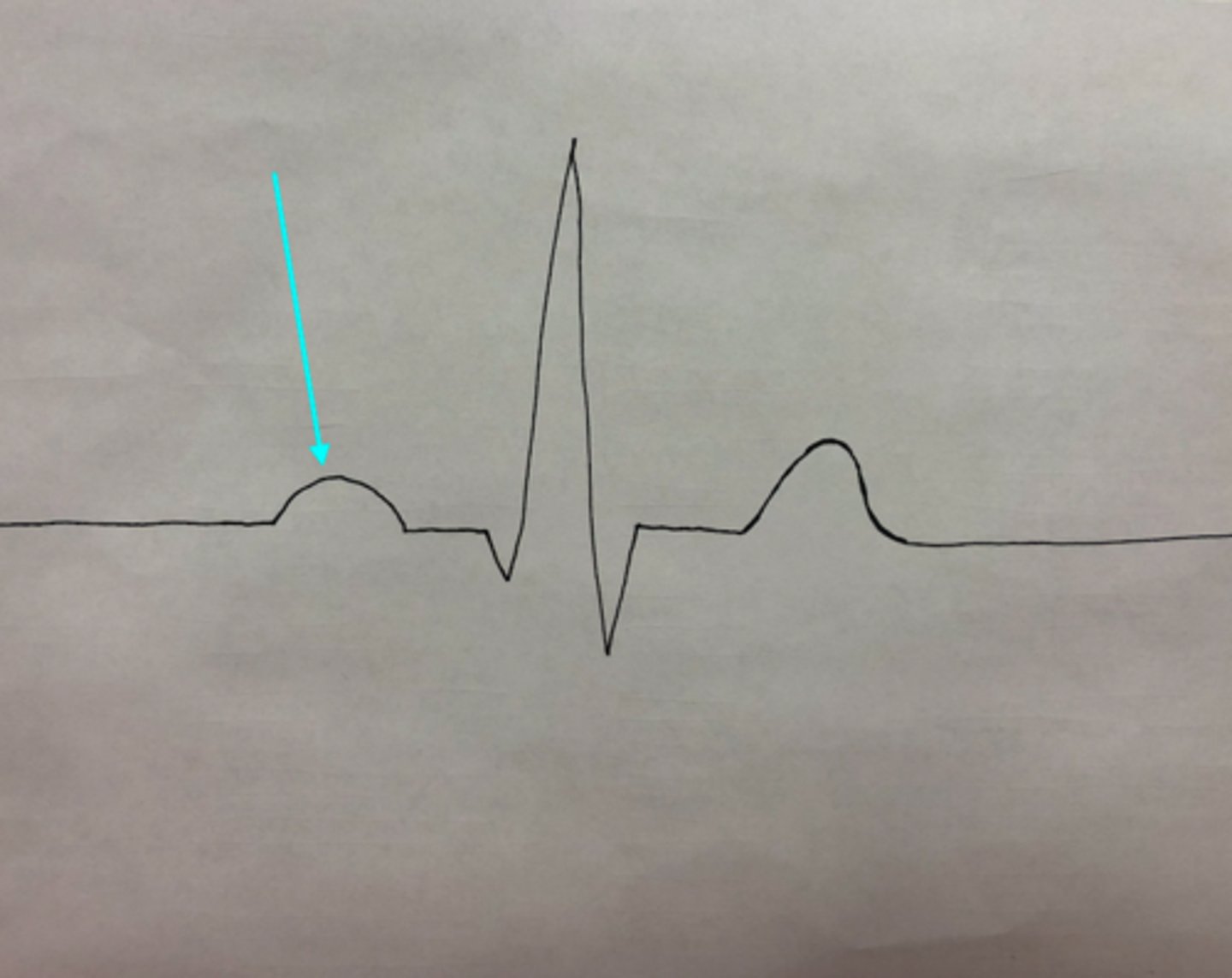 <p>What feature of an ECG is the blue arrow pointing at?</p>